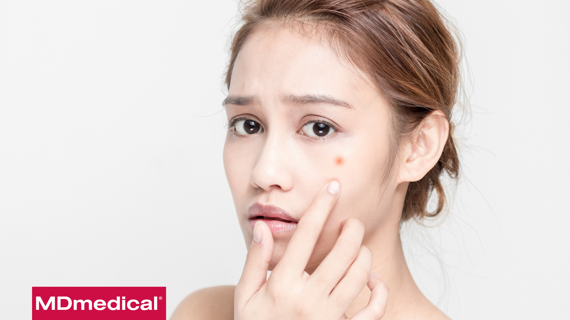 Bác sỹ tại MDmedical chỉ ra 4 sai lầm khiến mụn chồng chất mụn