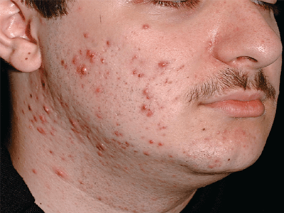 Làm thế nào để ngăn ngừa mụn bọc hiệu quả mà không làm tổn hại đến da?