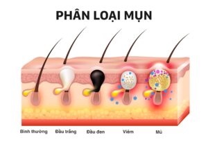 Nguyên nhân gây mụn