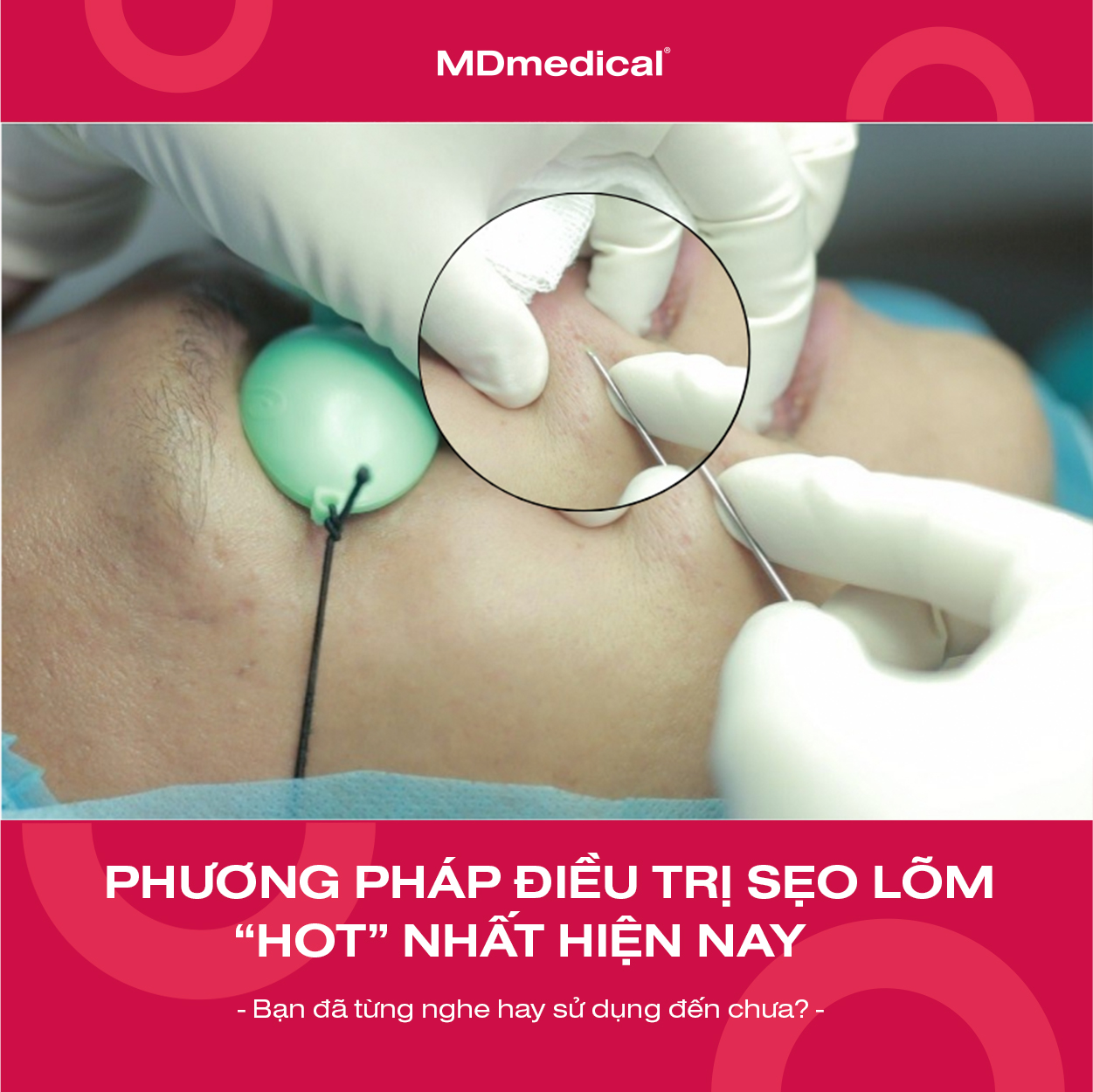DỊCH VỤ ĐIỀU TRỊ SẸO