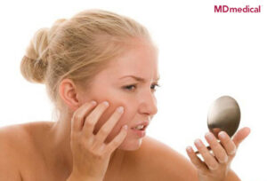 Làm thế nào để tìm được cách ngăn ngừa mụn trứng cá nhanh nhất?