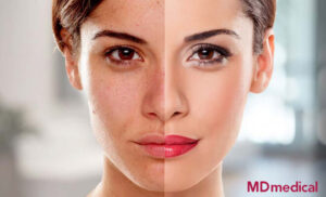 Hướng dẫn phác đồ điều trị làn da nhiễm corticoid tại MDmedical