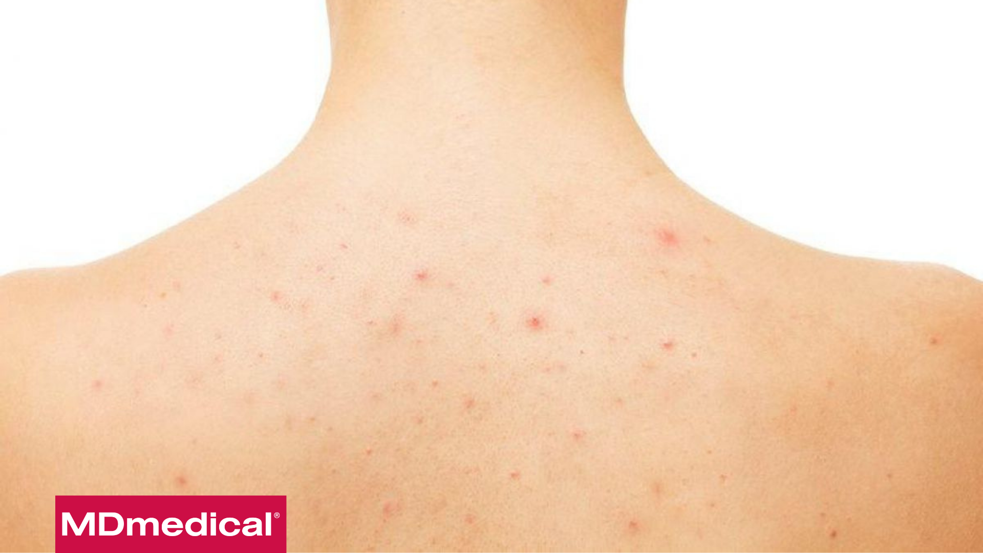 Hè đến rồi, phải nói lời tạm biệt với mụn ở lưng và ngực ngay thôi!