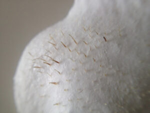 Mụn đầu đen và sợi bã nhờn: Nhầm một ly đi ngàn dặm?