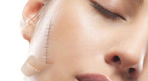 4 dưỡng chất quan trọng trong ngừa và điều trị sẹo lồi hiệu quả?