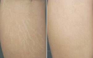 Tìm hiểu về trị sẹo tại MDmedical