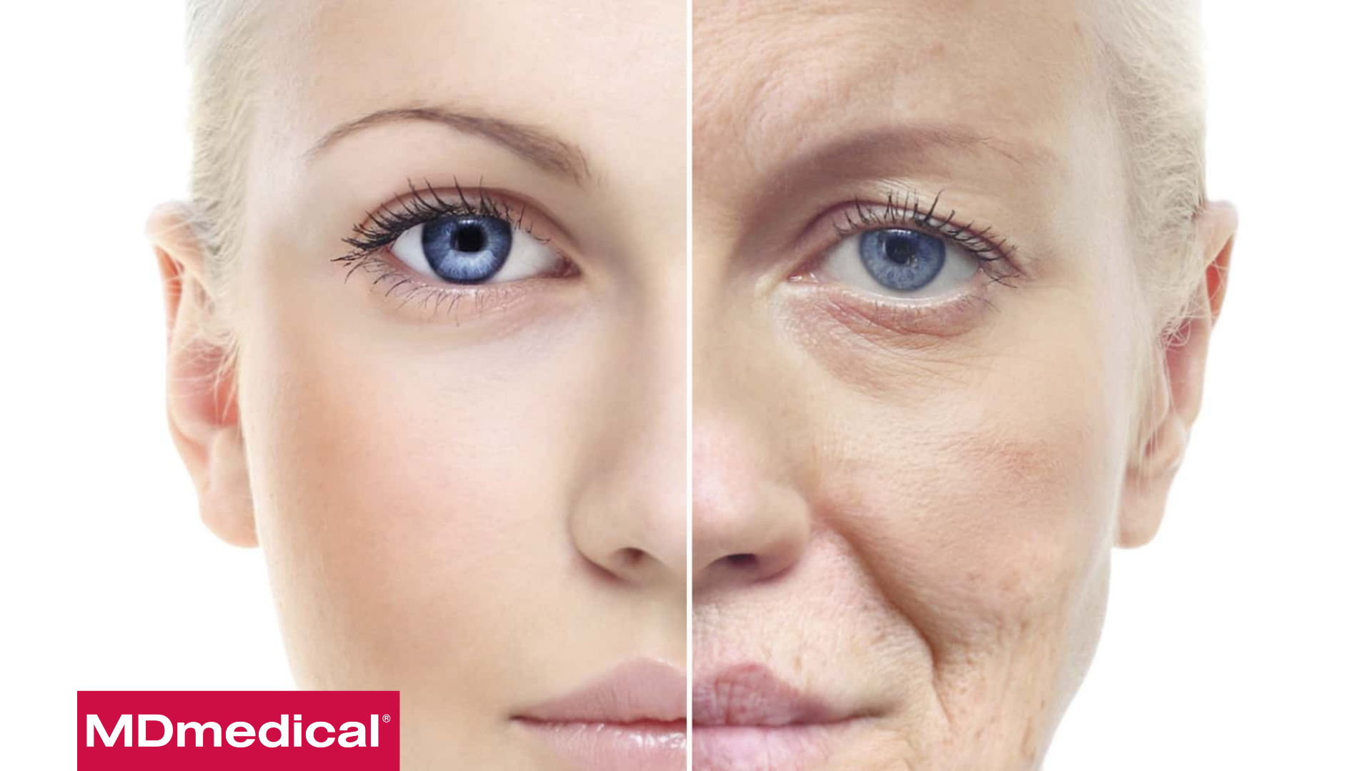 Lão hóa da và phương pháp trẻ hóa da bằng Laser